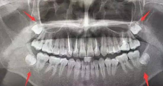 智齿是什么时候开始长的?成年后都会长智齿吗