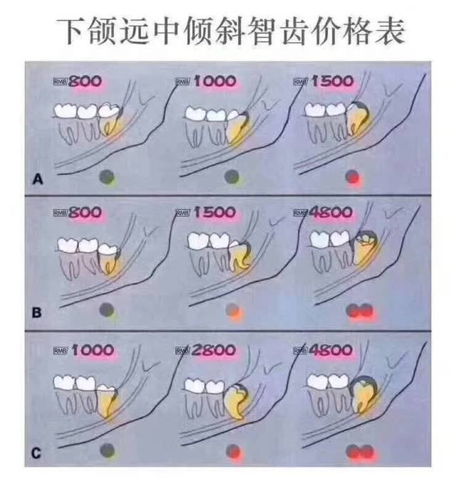 为啥拔智齿收费差别这么大?看了这3张图你就明白了