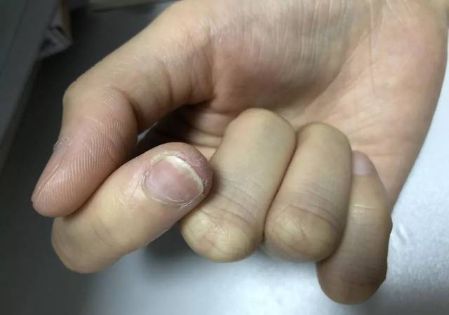 指甲变脆,剥离 若指甲变得薄脆易断裂,则可能是缺铁性贫血,营养不良