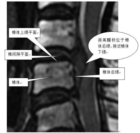 隔山打牛新技术取出躲到椎体后面的颈椎间