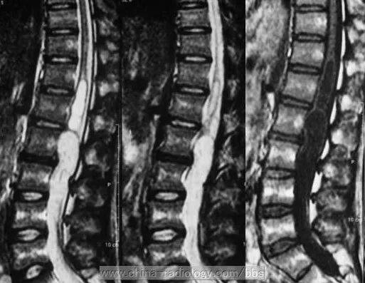 表皮样囊肿 腰椎管,等你分析 | 读片专栏1106期