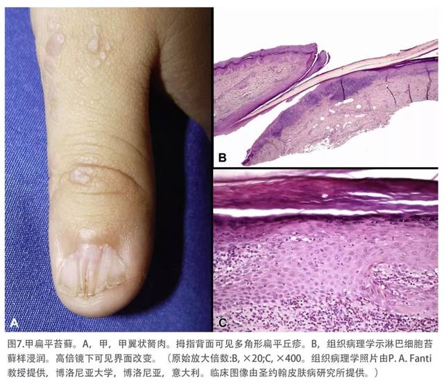 扁平苔藓和苔藓样皮炎临床综述及分子学基础