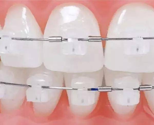 对比两者,自锁型牙套会有效的 减少牙套刮嘴的情况,矫正过程中 牙齿
