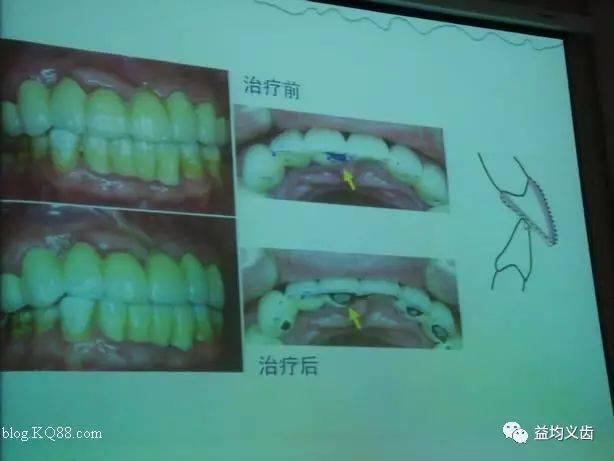 修复中的咬合问题及其处理原则