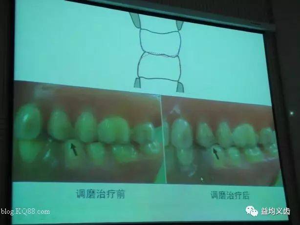 修复中的咬合问题及其处理原则