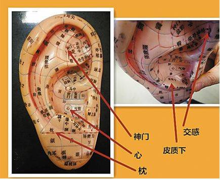 【微支招】耳穴压豆,拯救你的失眠