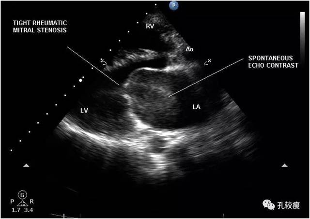 风湿性二尖瓣狭窄合并左心房重度自发显影