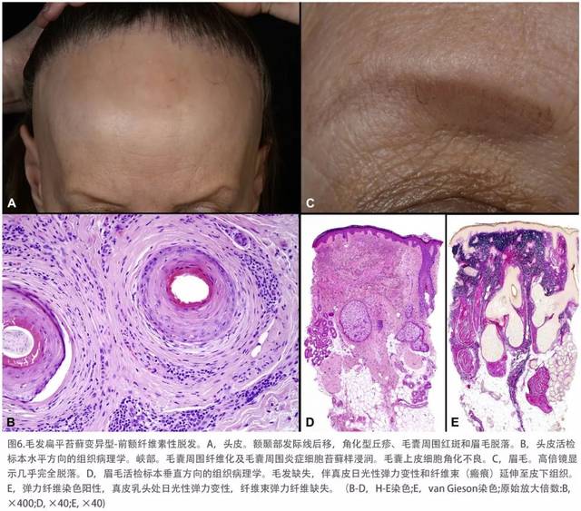 扁平苔藓和苔藓样皮炎临床综述及分子学基础