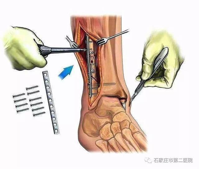 【马大夫讲"骨事"】骨折后打的钢板,钢钉,一定要取出来吗?