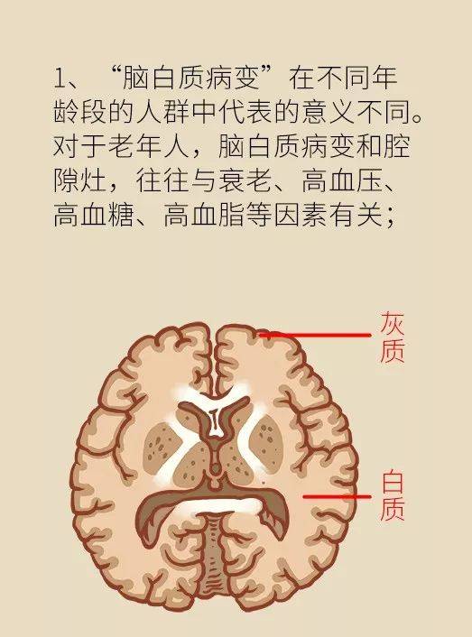"腔隙性脑梗"到底怎么回事?这篇文章全说透了!