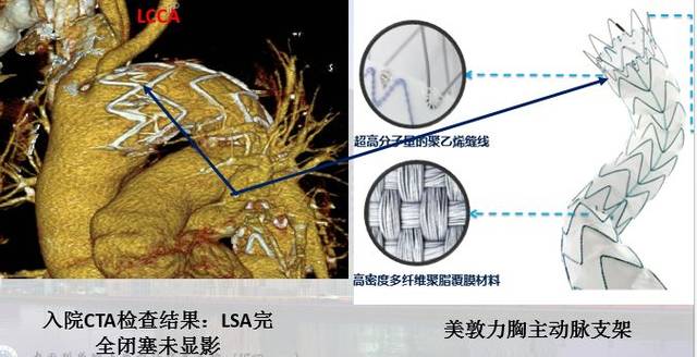 胸主动脉夹层(tevr)术后支架源性分支血管闭塞的ii期处理——(腔内篇)