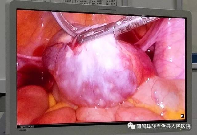 于6月14日在全麻下行腹腔镜卵巢囊肿剥除术,手术顺利,术后安返病房