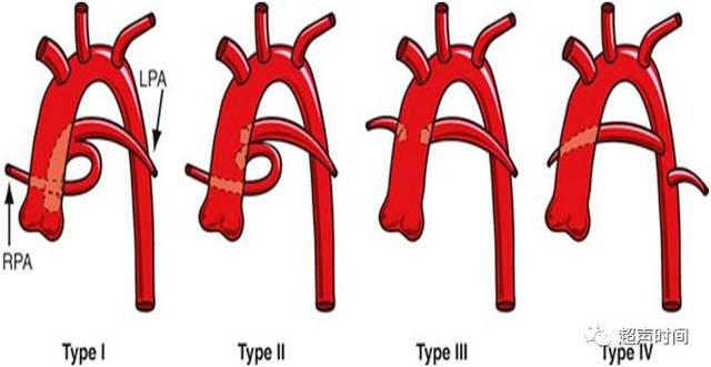 永存动脉干畸形的 collett 分型