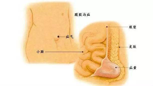 腹股沟疝示意图