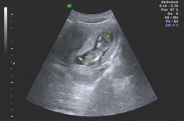 怀孕3个月,看懂b超单上这两个数据,胎儿就没有什么小秘密了