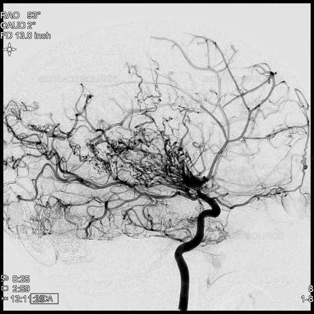 中级病例 | 烟雾病(moyamoya disease)影像表现