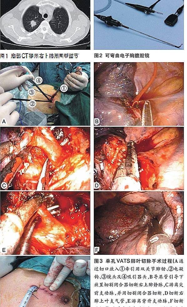单孔胸腔镜切除右肺腺癌