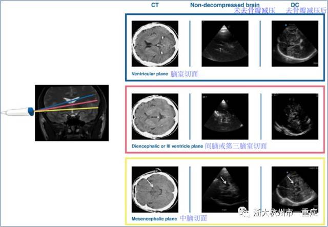 颅脑超声:方法,基本和高级原理,临床应用