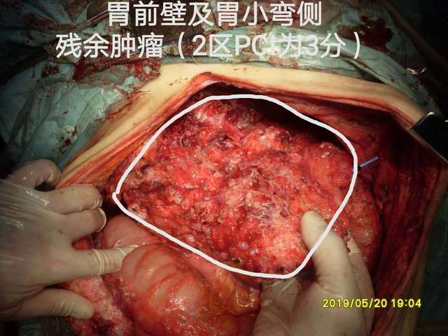 病例66--小阑尾大卵巢pmp晚期5次手术 (原创)