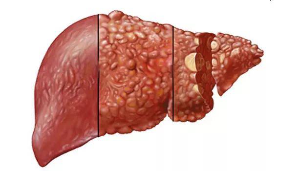 肝癌是一种危险度极高的发生在肝脏部位的恶性肿瘤,并且发现大多已经
