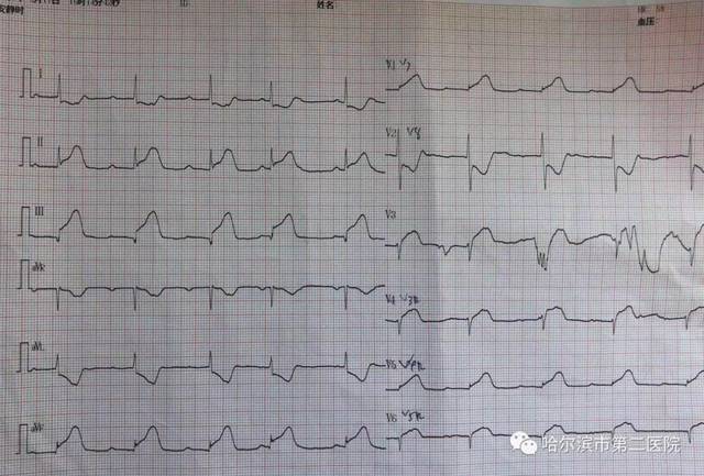 心电图显示急性下壁,右室心肌梗死伴iii度房室传导阻滞