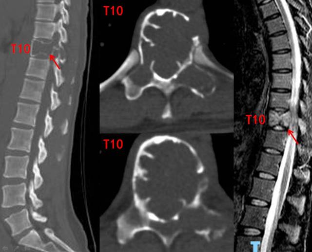 ct及磁共振显示:t10椎体椎体出现骨质破坏及异常信号,整个椎体被肿瘤