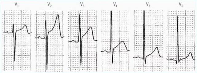 细数ST段抬高的N种原因,你可清楚?