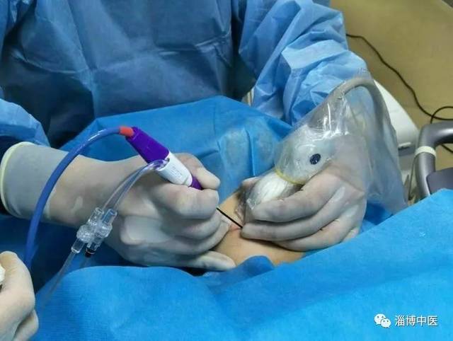 【临床医讯】甲状腺微波消融术你了解吗?