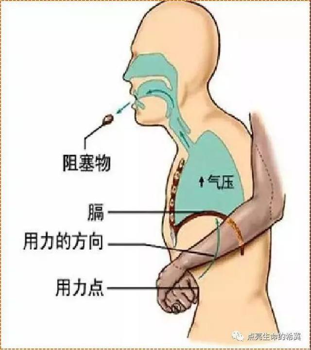 【人人学急救】吃东西被"噎住"怎么办,快来了解这些急救小知识