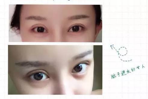 割双眼皮花了50万,水光针当饭吃!整容后年入千