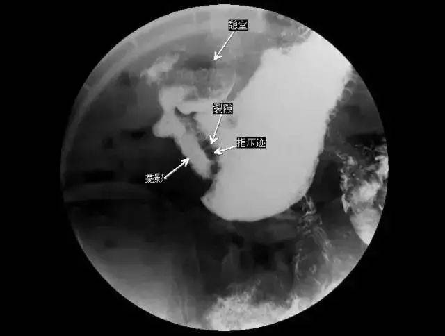 医学美图 | 消化道造影片之胃篇