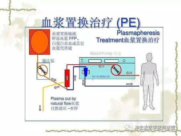 血浆置换疗法与血脂净化