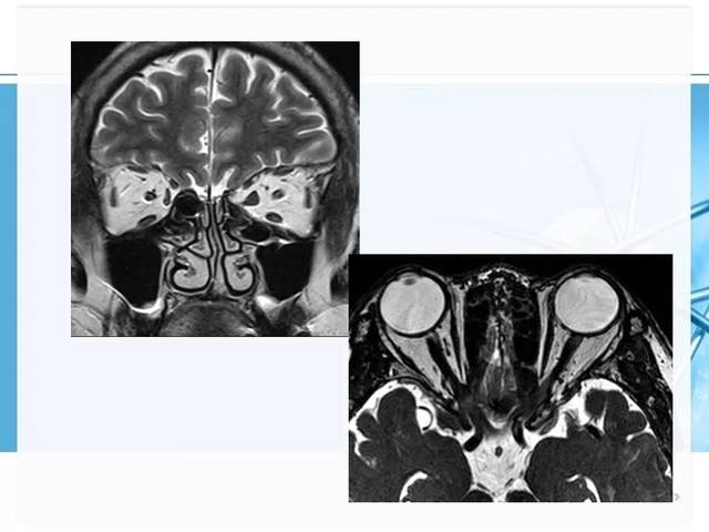 眼眶及眼球病变mr表现 影像天地