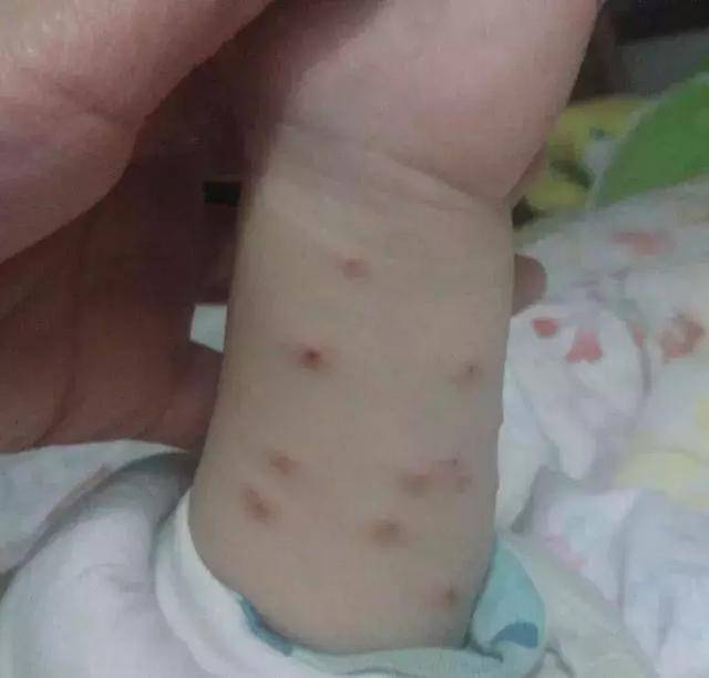 宝宝被蚊虫叮咬后,瘙痒红肿如何处理?
