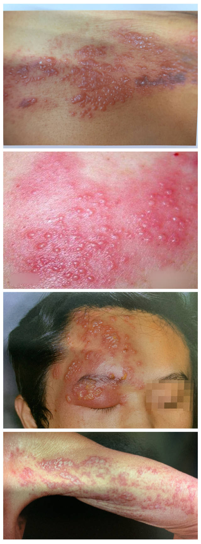 图片来源网络及《中国皮肤病性病图鉴》(第2版) 在古代,由于医疗科学