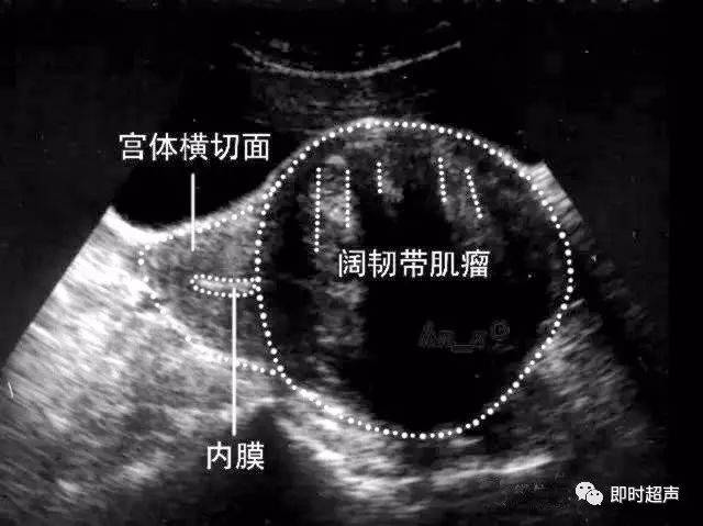 图8-3-10 阔韧带肌瘤声像