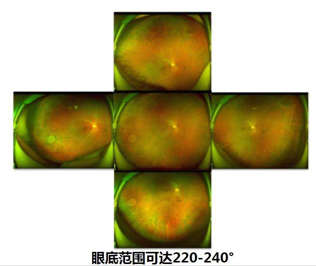 超广角眼底照相—欧堡入驻贵港爱尔眼科医院啦!