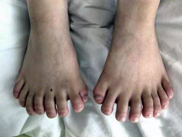 11,这是一个中国男孩,他出生的时候有16个脚趾,不过后来做手术去除了