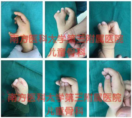 在7~8周时,如果胚胎受到极轻微损伤,手指的发育分化局部停顿,掌板产生