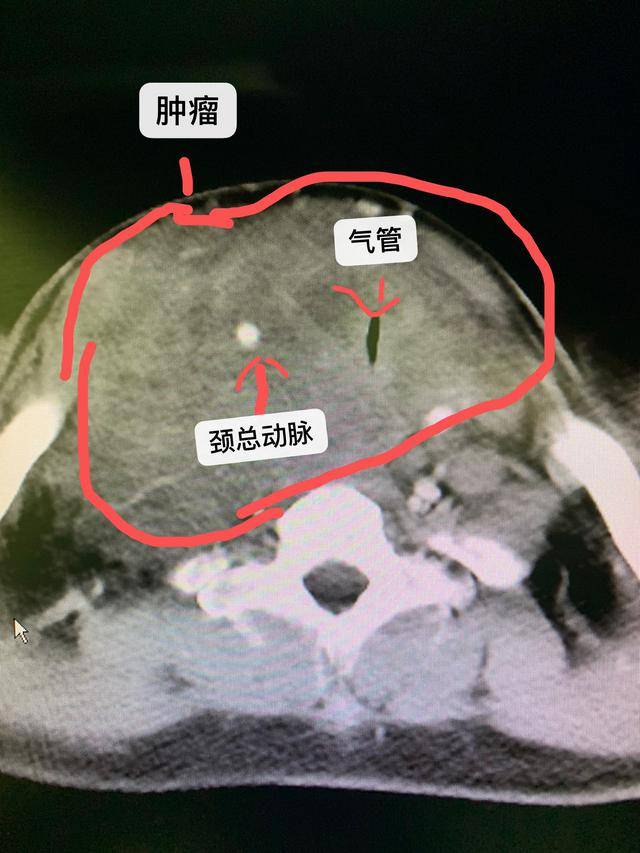 小伙儿颈部包块疯长,压迫气管成了"一线天"