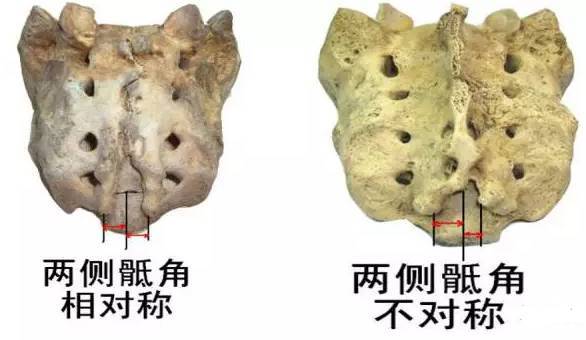 产生原因: 骶椎隐裂为多基因遗传病,其发病有种族,地区差异