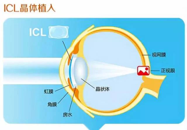 icl晶体植入术前需要做哪些检查?