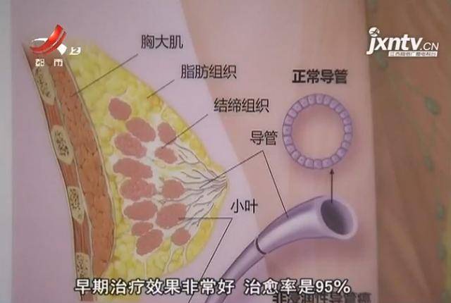 南昌:90后妈妈查出乳腺癌晚期 曾有这个征兆 自己没重视