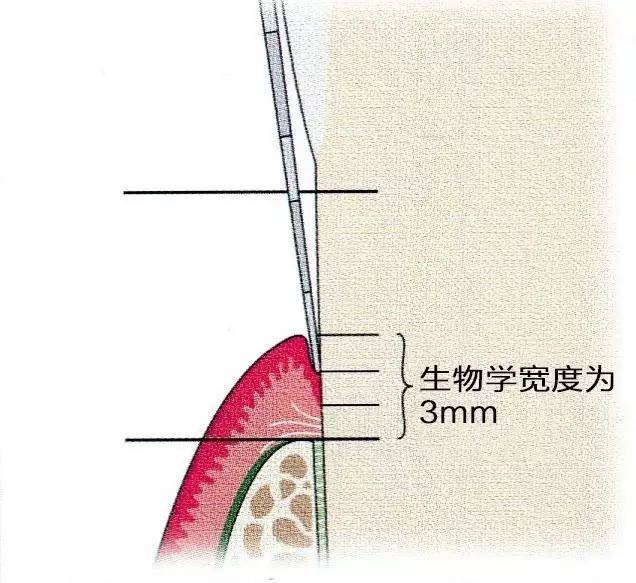 维持了相对稳定的生物学宽度:龈沟深度约1mm,结合上皮长度约1mm,结合