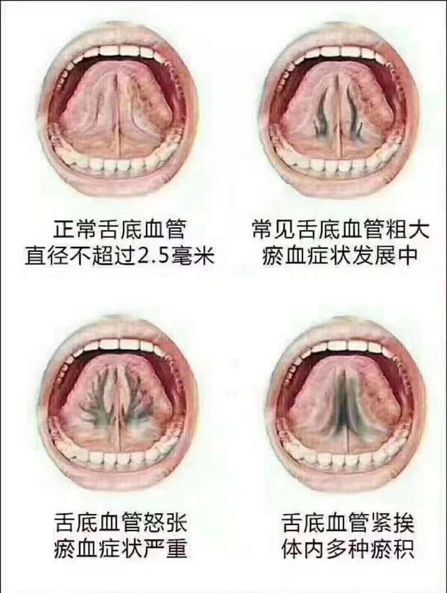 舌下的两条血管弯弯曲曲,而且有些扭曲发紫发青,这种情况就预示着有