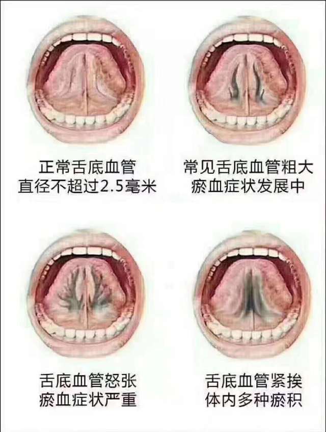 百病之源血瘀症,最易忽略的身体信号成为最大健康杀手