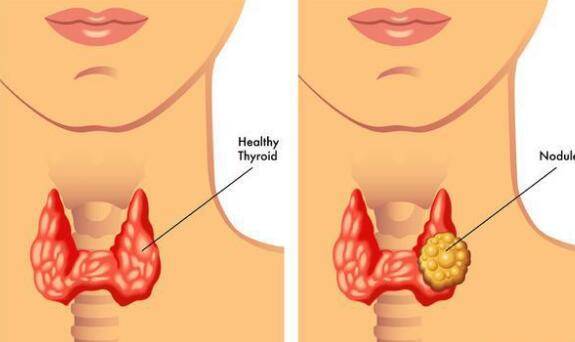 体检查出甲状腺囊肿、实性结节,到底会不会癌