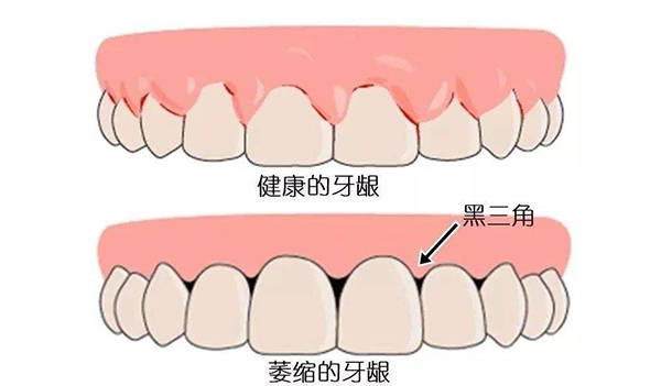 牙龈黑三角可以恢复吗?