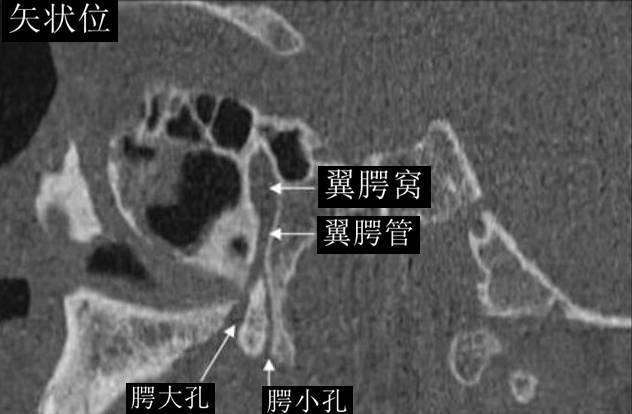 一文搞懂复杂解剖:翼腭窝(必点收藏)