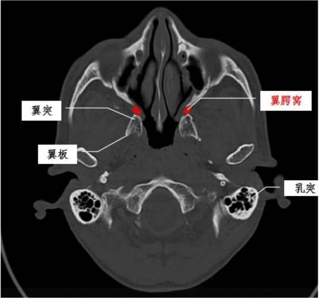 孔 后上:圆孔---颅中窝 后下:腭鞘管---鼻咽 蝶骨大翼后壁蝶骨体腭骨